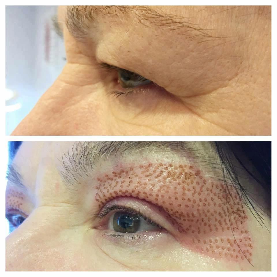 fibroblast-skin-tightening-redcar-middlesbrough