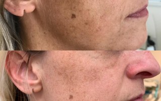 Pigmentation on face