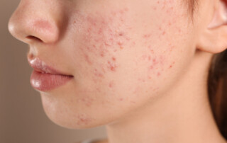 Girl with acne skin and spots