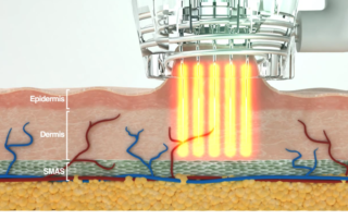 RF Microneedling layers of the skin